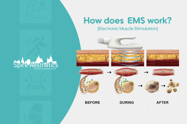 EMS treatment for post pregnancy weight loss treatment Balsall