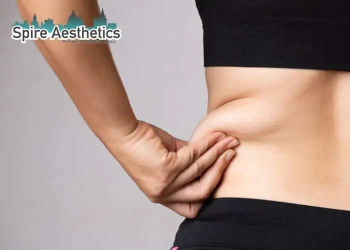 Image of woman pinching fat on their hips Balsall. Fat Freezing treatment