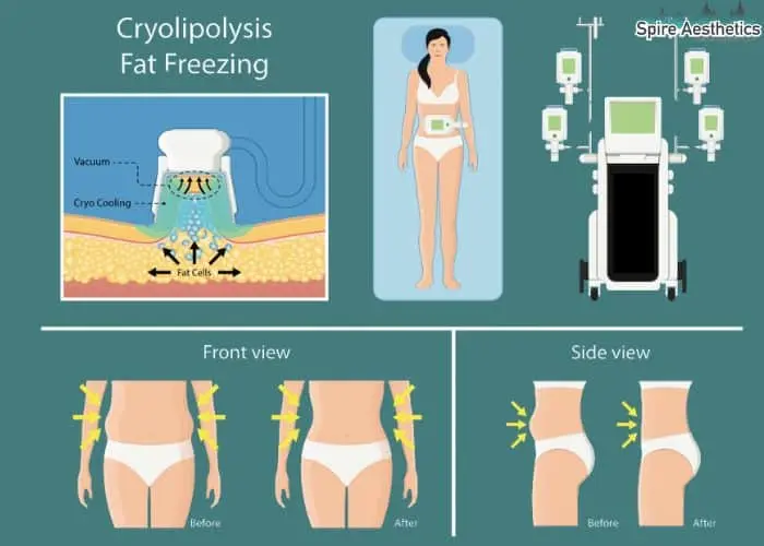 Fat freezing treatment Balsall benefits for competitions to remove stubborn fat deposits.