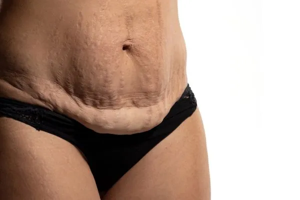 Image of womans stomach after weight loss injections Balsall showing saggy skin