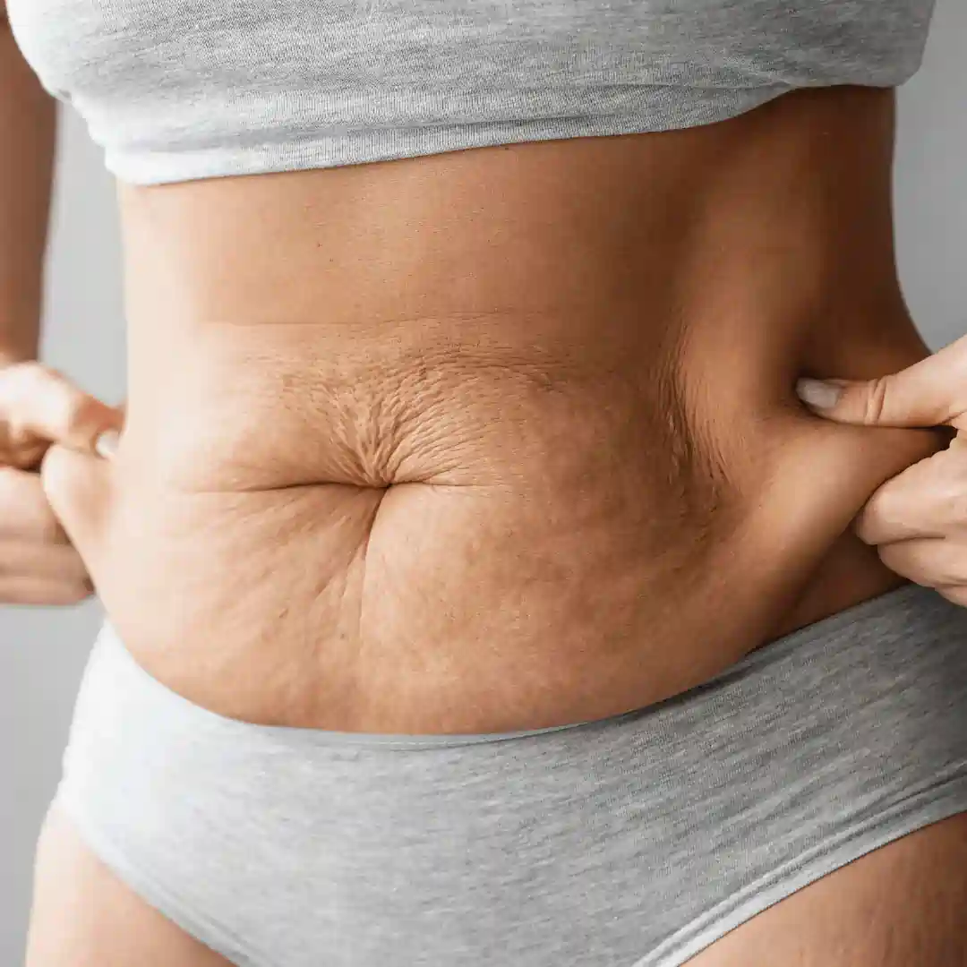 Is It Normal to Have Loose Skin After Pregnancy Balsall?